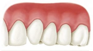 Gum Recession