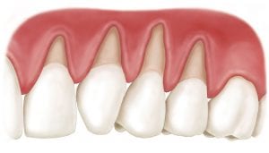 Gum Recession
