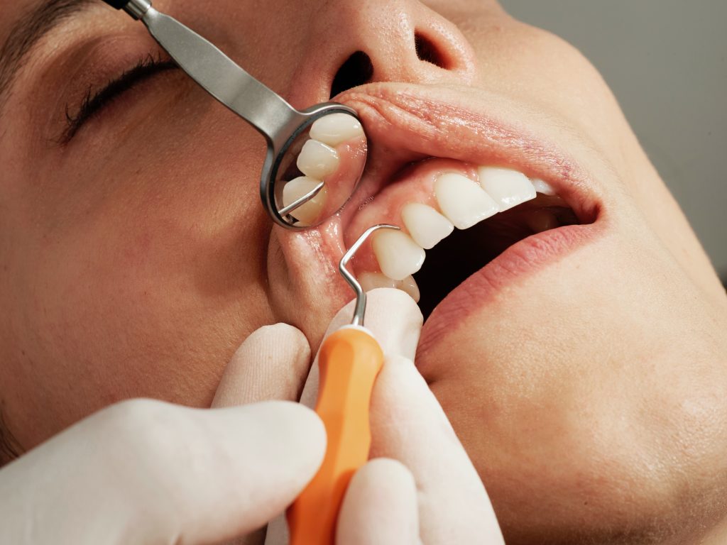 gingivectomy in parker and glendale co Dr. Maryanne. Butler Dr. Amy M. Riffel Mountainview periodontics & Dental Implants General, Cosmetic, Restorative, Family Dentist in Parker, CO 80138 & Glendale CO 80246