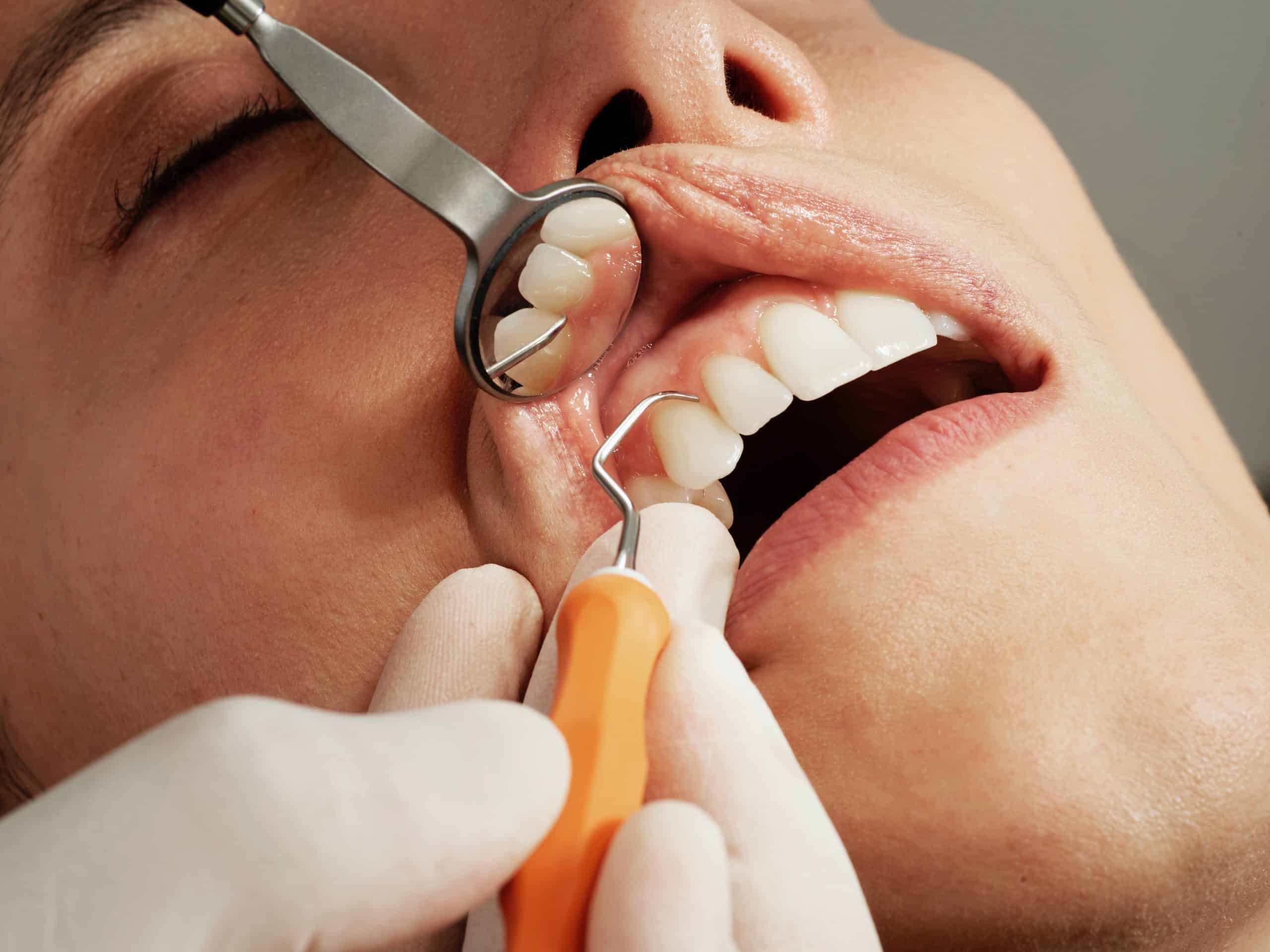 gingivectomy in parker and glendale co Dr. Maryanne. Butler Dr. Amy M. Riffel Mountainview periodontics & Dental Implants General, Cosmetic, Restorative, Family Dentist in Parker, CO 80138 & Glendale CO 80246