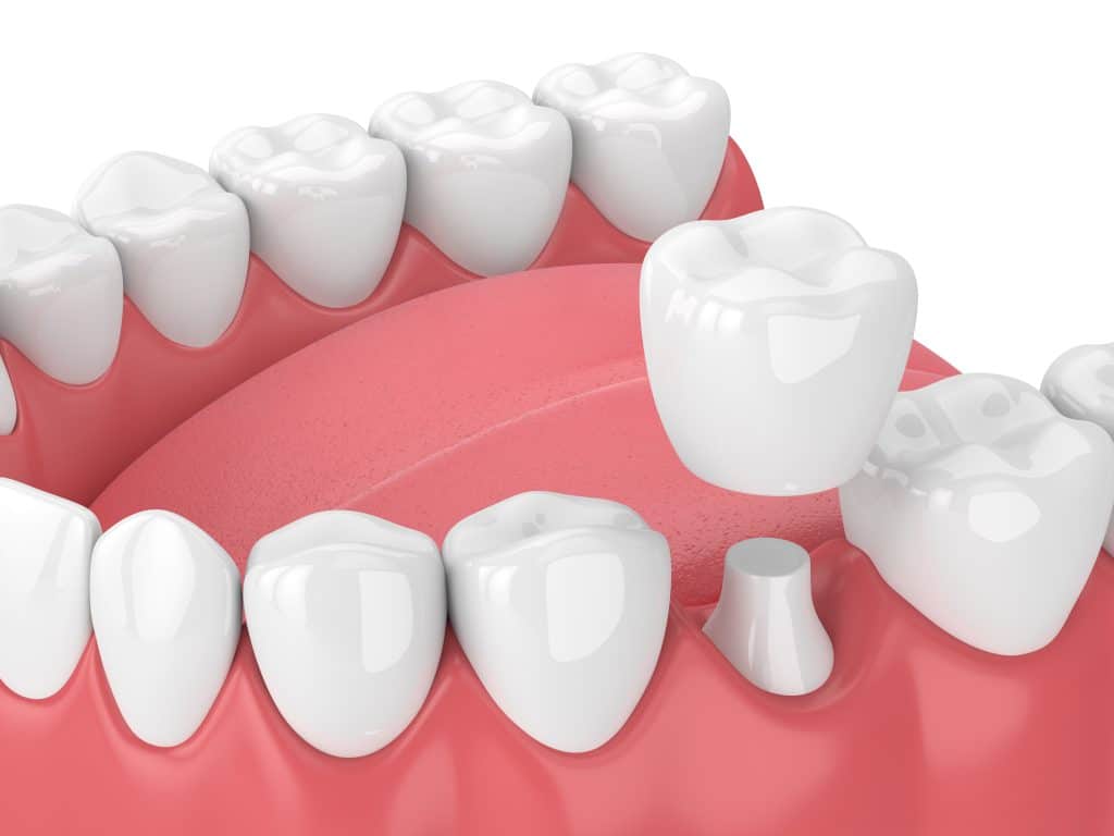 crown lengthening in parker and glendale co Dr. Maryanne. Butler Dr. Amy M. Riffel Mountainview periodontics & Dental Implants General, Cosmetic, Restorative, Family Dentist in Parker, CO 80138 & Glendale CO 80246