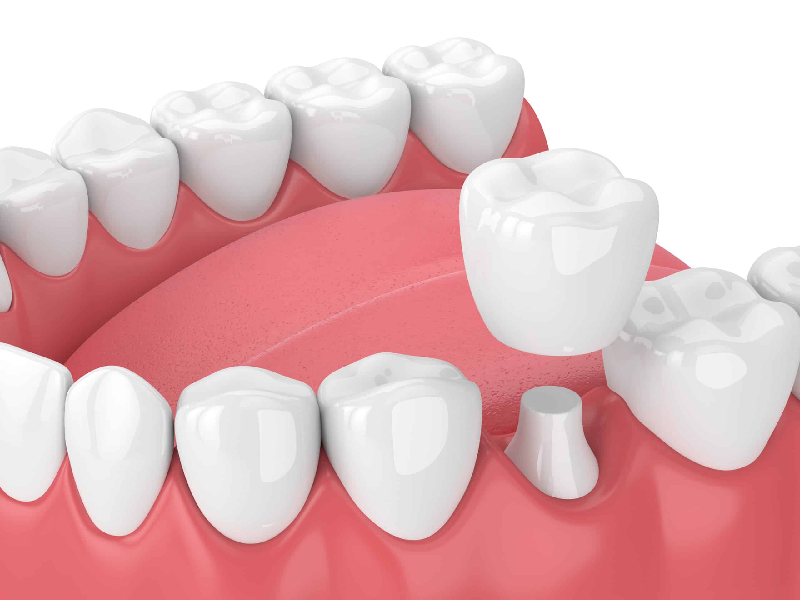crown lengthening in parker and glendale co Dr. Maryanne. Butler Dr. Amy M. Riffel Mountainview periodontics & Dental Implants General, Cosmetic, Restorative, Family Dentist in Parker, CO 80138 & Glendale CO 80246