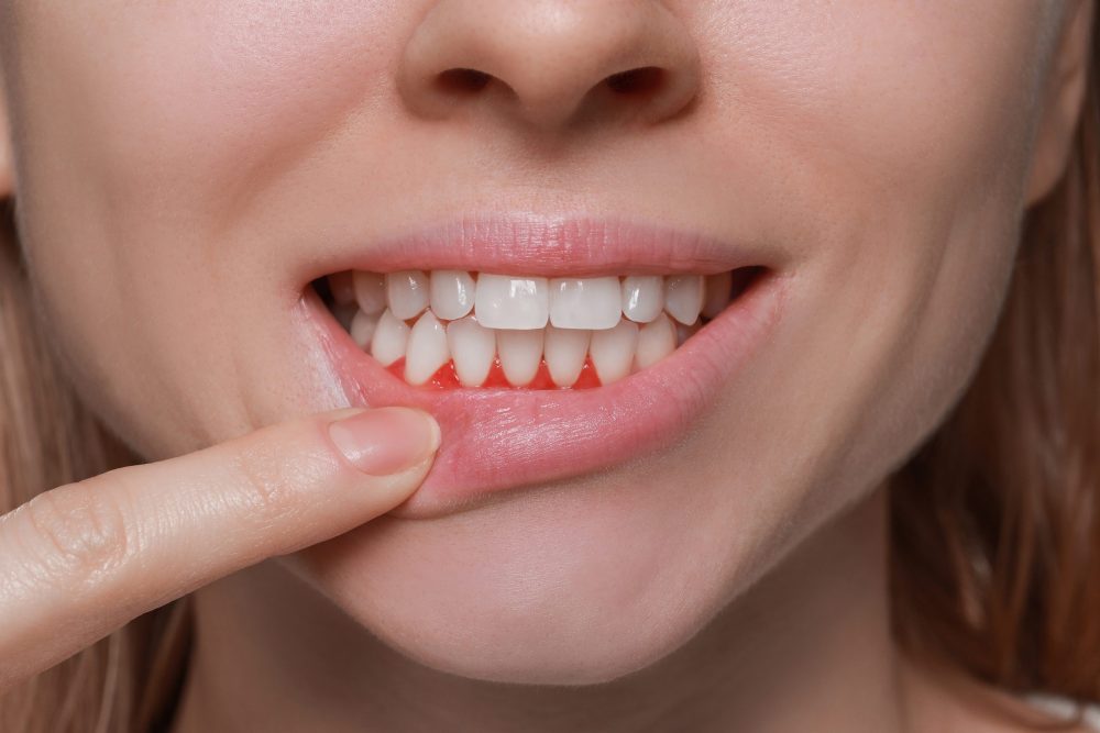 Periodontal Cleaning Parker