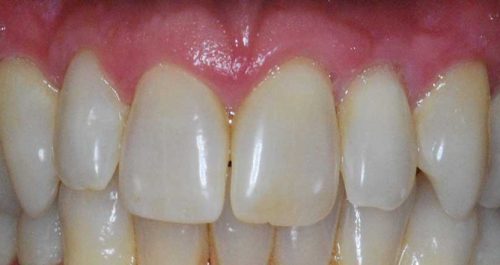 ctg After