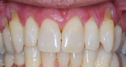 ctg Before