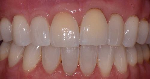 full mouth ctg post