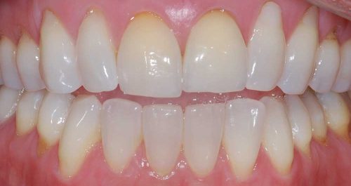 full mouth ctg pre